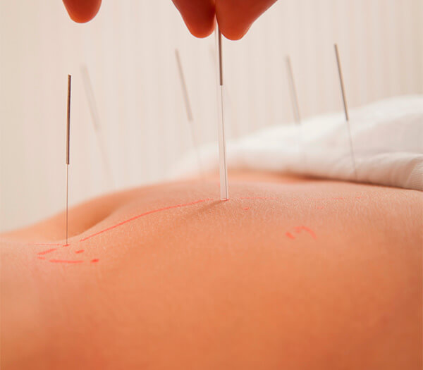 Acupuntura